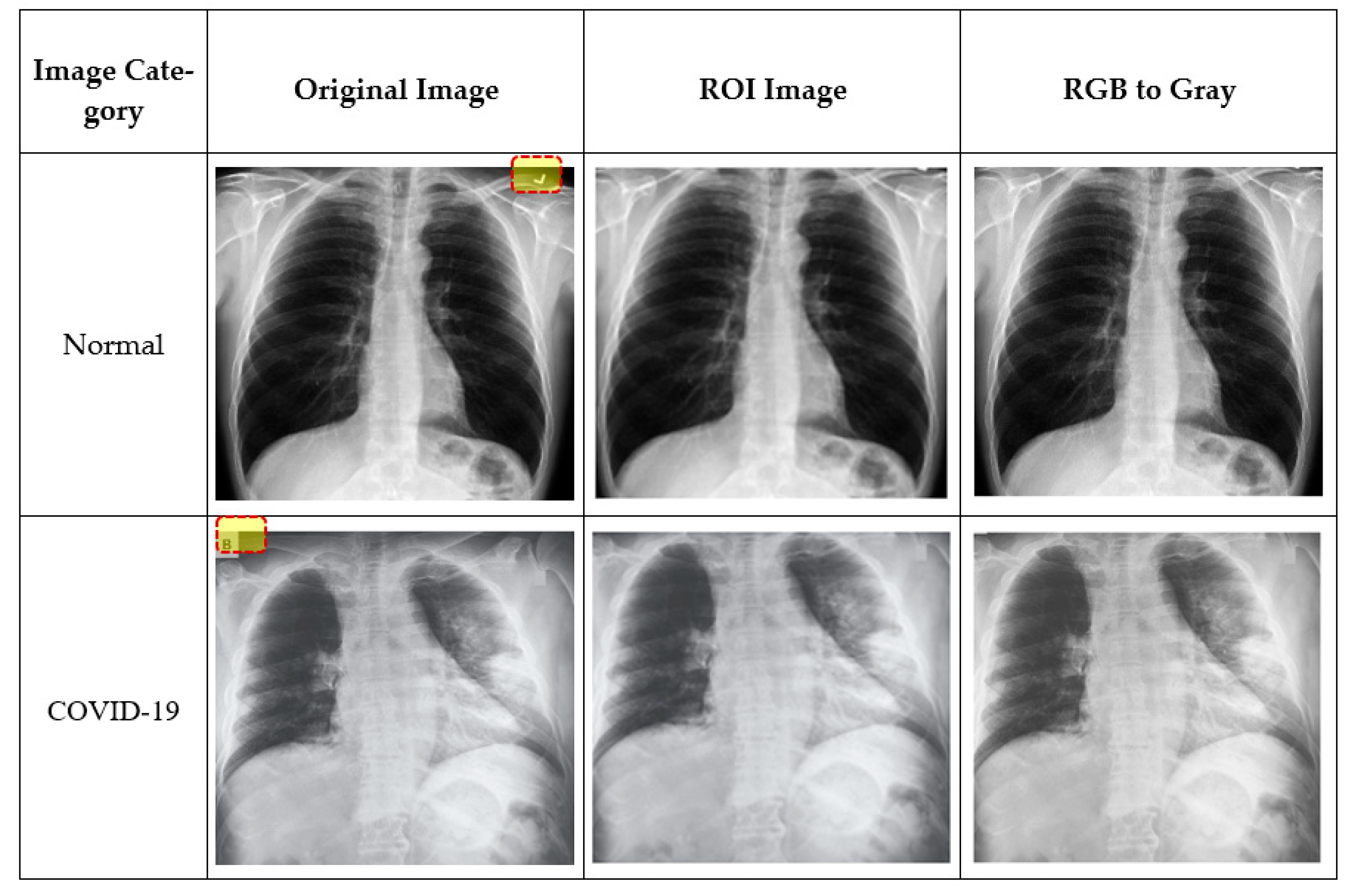 COVID-19 Detection